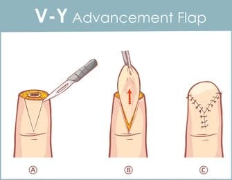 Advancement-Flap-Procedure
