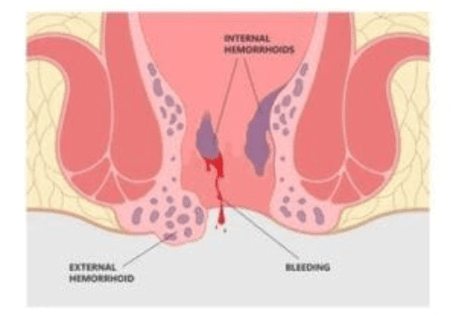 Infrared-Coagulation