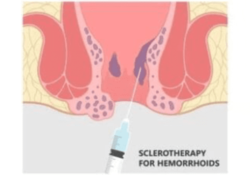 Laser-Hemorrhoidopexy