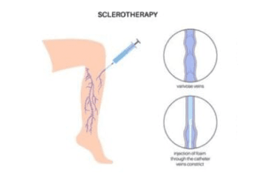 Sclerotherapy