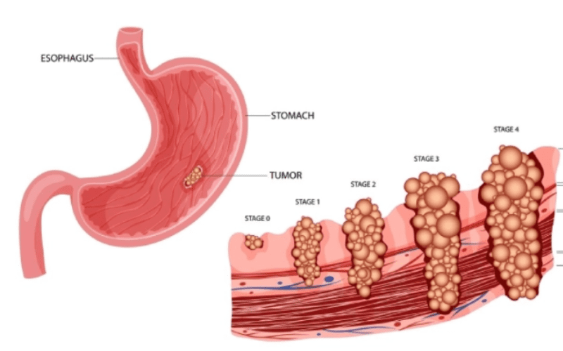 Stomach-Cancer