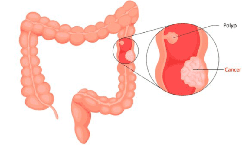 colon-cancer