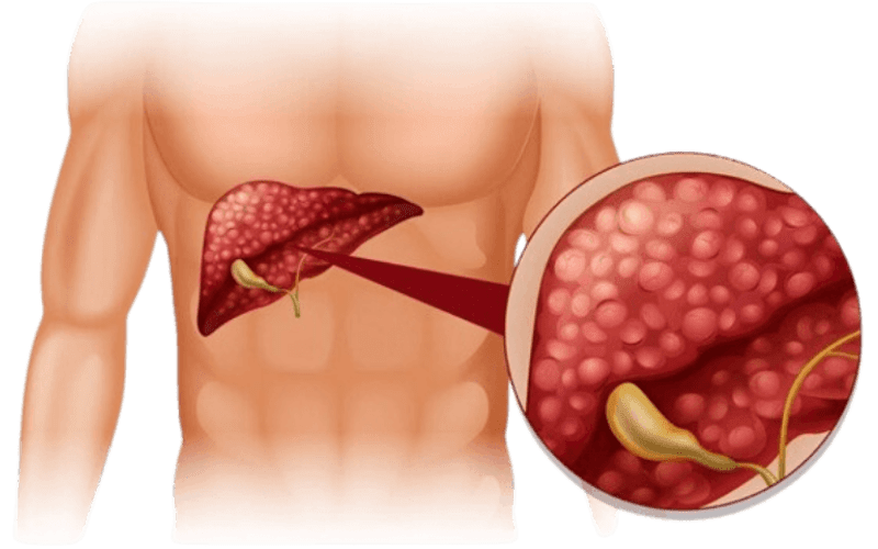 liver_cancer