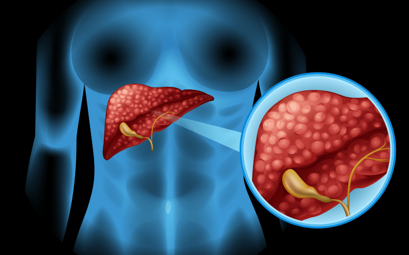 liver_cancer_5