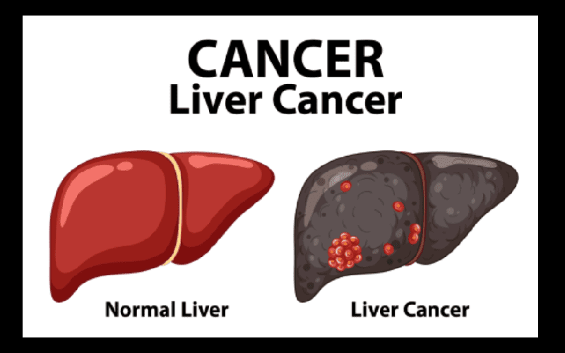 liver_cancer_6